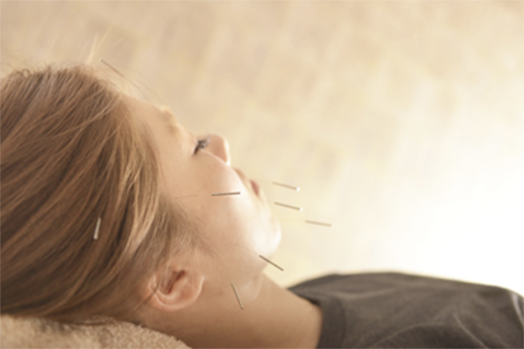 美容鍼(美顔鍼)とは1